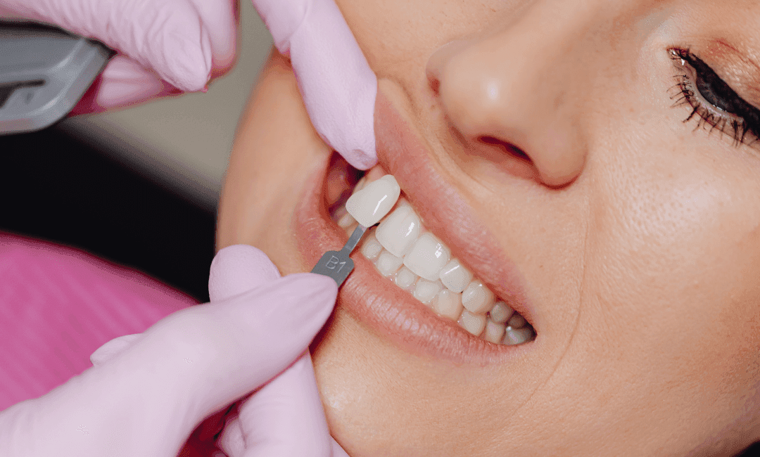 Prueba de color para carillas dentales en tratamiento de estética dental, mejora de la sonrisa del paciente.