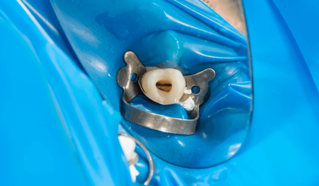 Imagen de una endodoncia en proceso, tratamiento de conductos realizado en Clínica Dental RM en Montequinto.