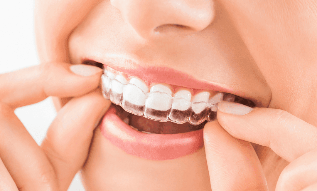 Mujer colocándose alineador transparente de ortodoncia invisible para corregir la posición dental de forma estética.